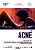 Acné