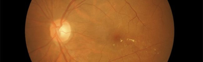 que es la retinopatia