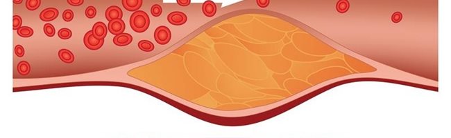 hiperlipemias y colesterol