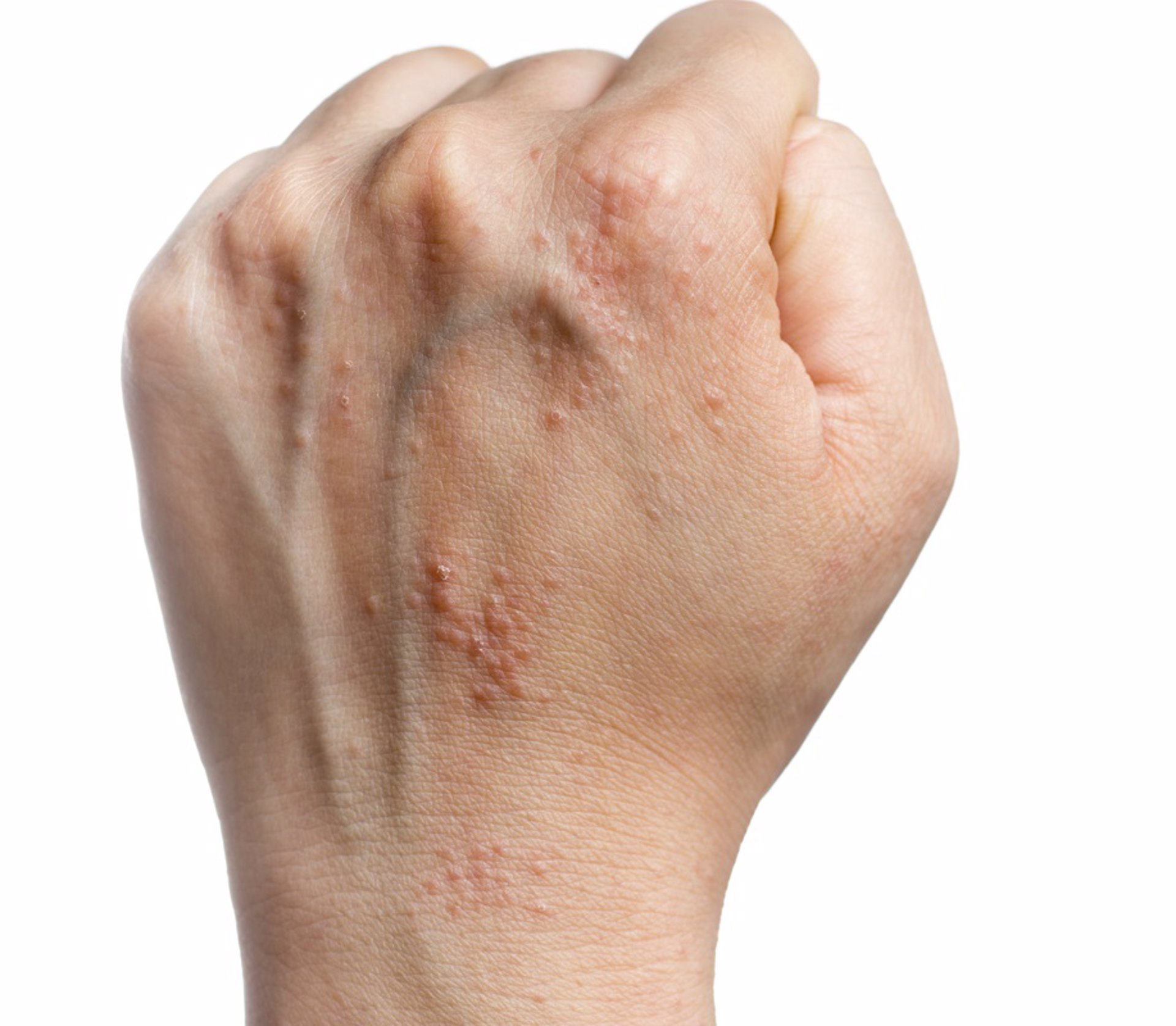 Eczema, eccema, urticaria, alergia en la piel