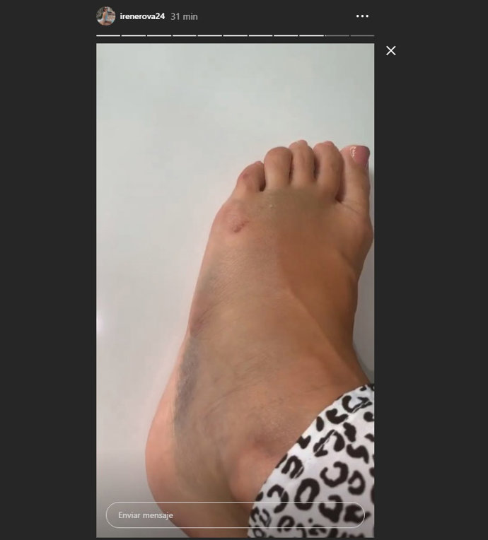 Pie amoratado de Irene Rosales