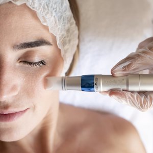 Nanopore Pen está indicado para atenuar los poros, uniformar el tono de la piel y reducir las arrugas