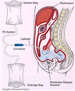 Diálisis peritoneal