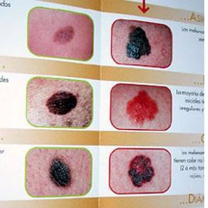 Desvelan el mecanismo básico de desarrollo del cáncer de piel