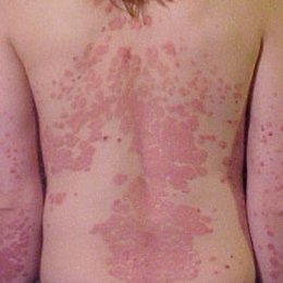 psoriasis