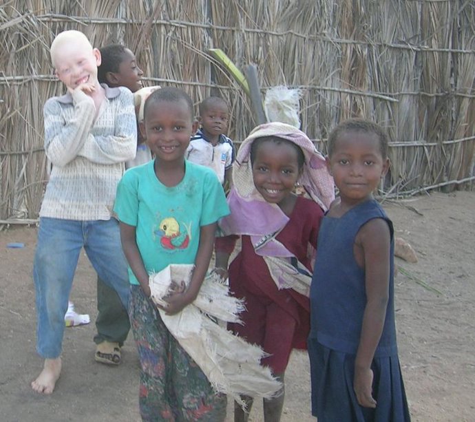 niño albino tanzano