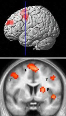 Areas cerebrales que se activan ante una persona odiada