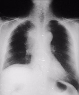 radiografía de pulmón, cáncer 