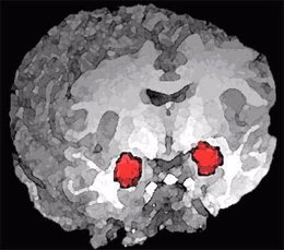 Amígdala Cerebro