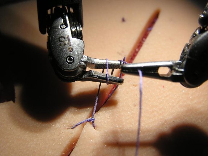 Un momento de la operación mediante el robot Da Vinci