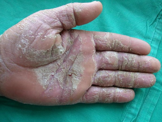 Eczema Crónico de las Manos