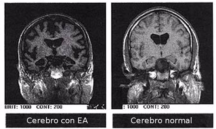 cerebro con alzheimer