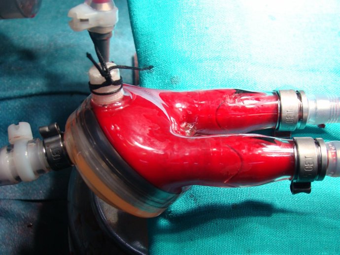 Corazón artificial implantado a un niño de ocho meses