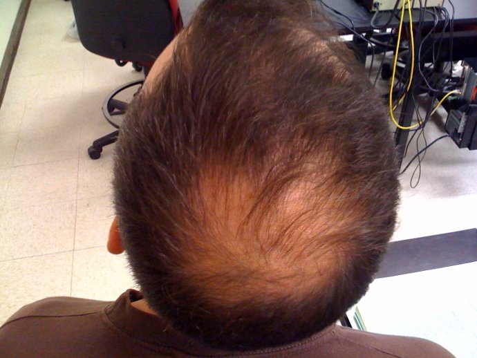 Alopecia calvo calvicie