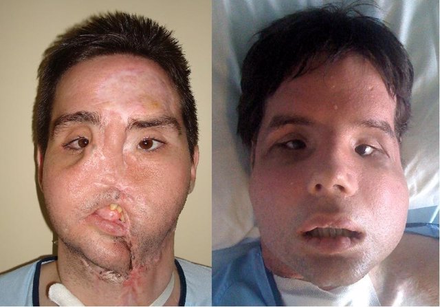 El primer trasplantado total de cara, antes y después de la intervención