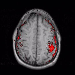 Radiografía cerebro con signos de infarto