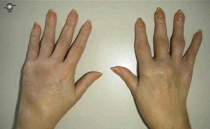 Manos afectadas por una ER