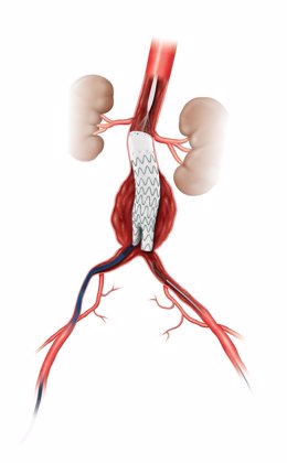 Infográfico del catéter implantado a un paciente con aneurisma en la aorta