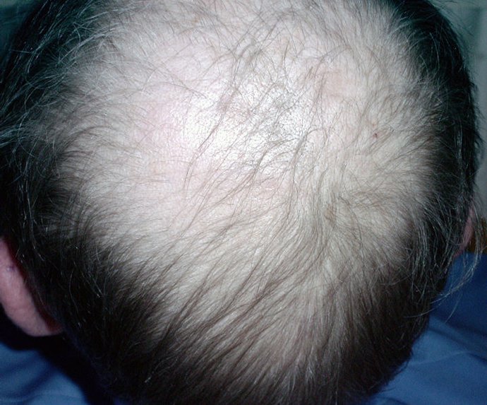 calvicie, alopecia