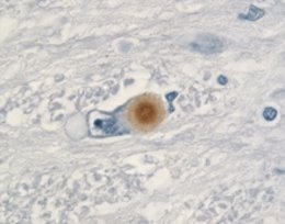 Investigan sobre la muerte neuronal de los enfermos de Parkinson