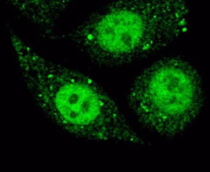 Células de cáncer de colon con moléculas antitumorales atrapadas en el núcleo