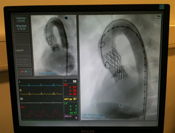 Imagen de la colocación de la válvula