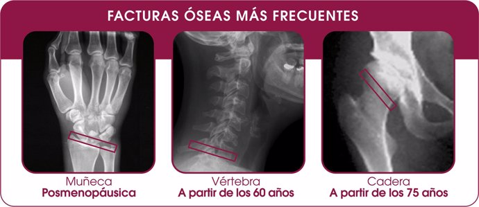 sedentarismo fracturas oseas