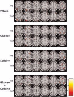 Contraste cerebral, estudio Universidad de Barcelona sobre glucosa y cafeína