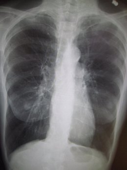 Enfermedad pulmonar obstructiva crónica (EPOC)