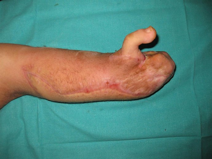 Reconstrucción de la mano