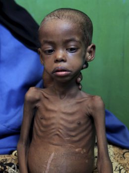 Niño desnutrido en Somalia