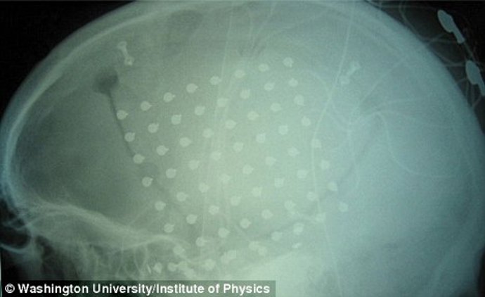 cerebro con implante de electrodos