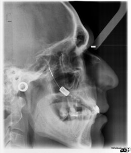 Dispositivo Que Permite Reducir Dolores De Cabeza
