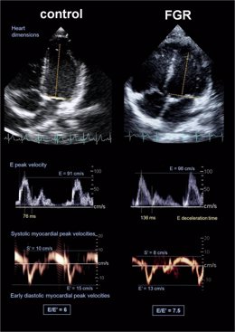 Radiografía. A La Izquierda, Corazón Bebé Normal Alargado. A La Derecha, Ensanch