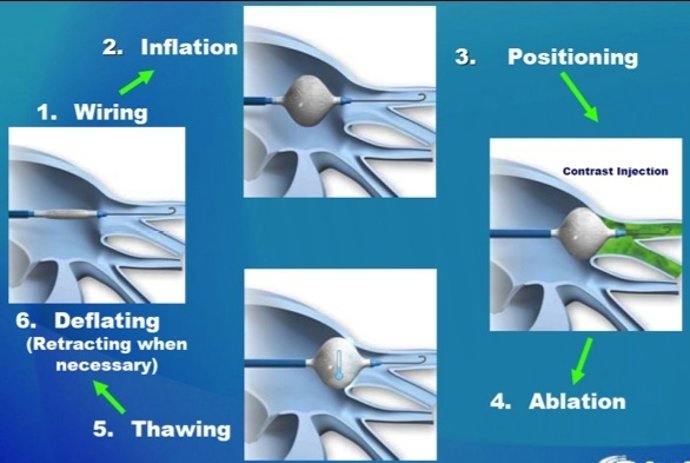 Técnica Que Aplica El Clínica En Arritmias