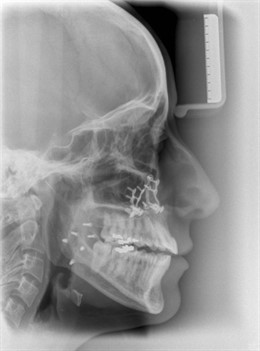 Perfil De Un Craneo En Una Radiografía