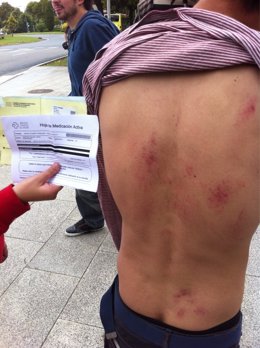 Un Joven Muestra Sus Heridas En La Concetración De Los Indigandos En San Caetano