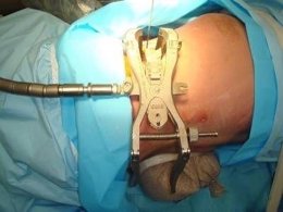 Neurocirujanos De Elche Forman En Una Técnica De Intervención De Espalda