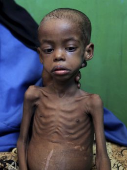 Niño desnutrido en Somalia