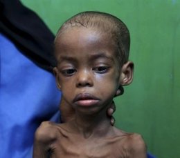 Desnutrición En Somalia