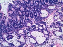 Tumor de colon cuyo crecimiento está inhibico con enoxacina
