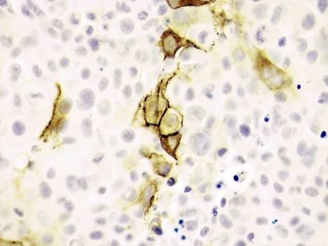 Las Células De Melanoma Con Los Vectores Virales -Telomerasa
