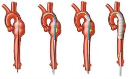 Ejemplo De Cirugía Endovascular