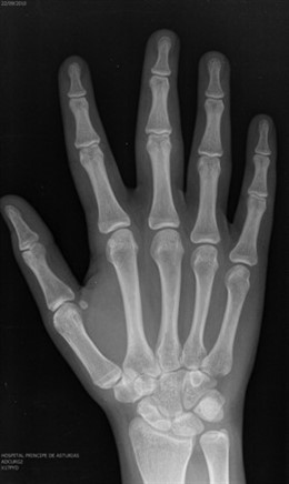 Prueba Radiológica Para Determinar La Edad