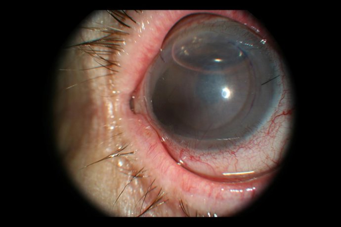 Trasplante Endotelial En El Ojo