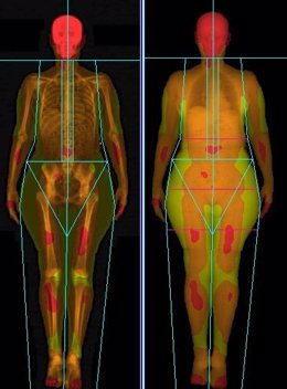 Escaner De La Composición Corporal Con La Masa Grasa De Paciente Con Obesidad