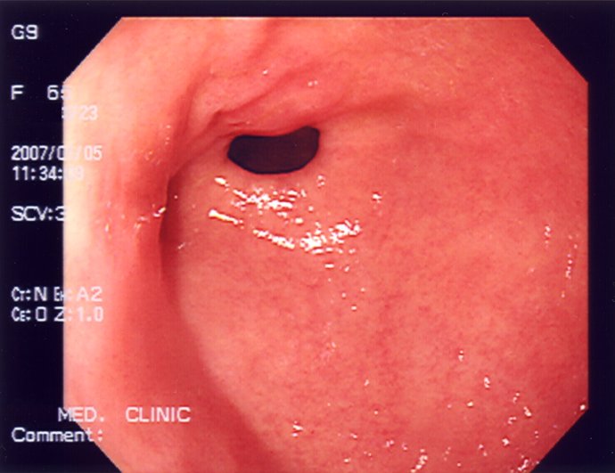 Imagen De Una Endoscopia