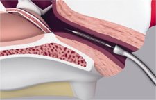 Se Puede Solucionar La Otitis Crónica