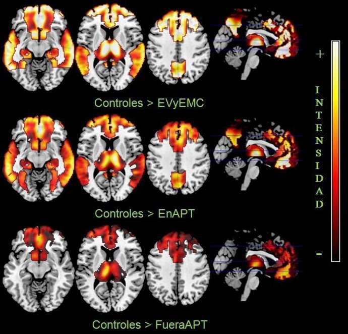 Estudio Sobre La Evolución Del Traumatismo Craneoencefálico