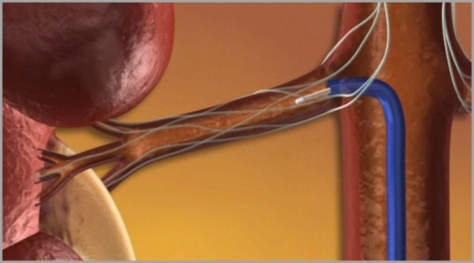 Catéter En Los Riñones Contra La Hipertensión